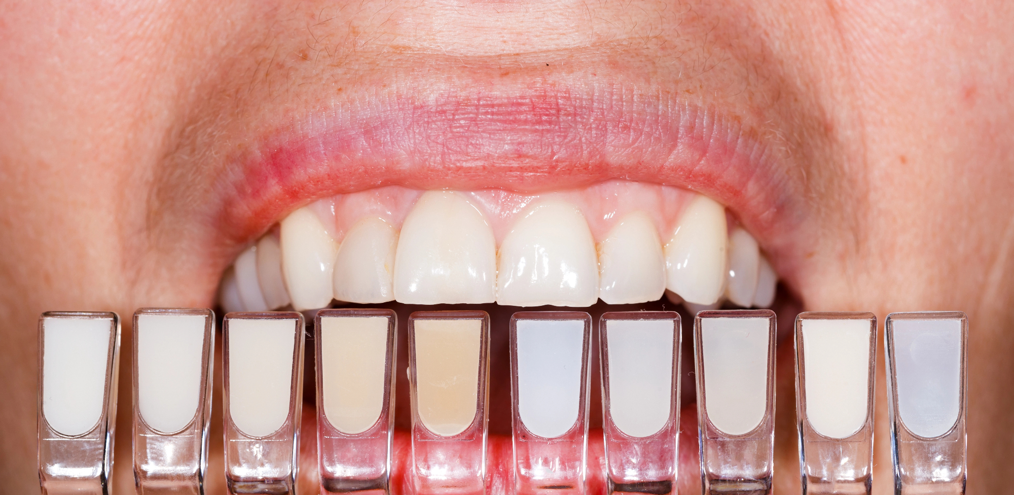 Za rešitev zoba in nasmeha so se ji zobne prevleke obrestovale